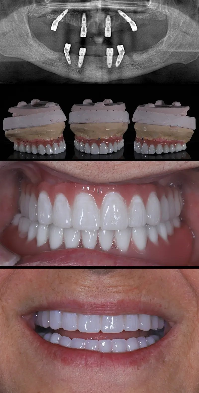 Caso clínico de cirurgia de implantes dentários.