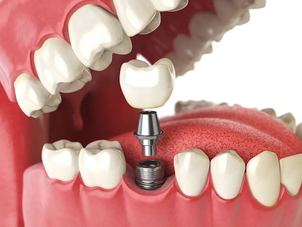 Ilustração de um implante dentário em titânio com pilar e coroa dentária, demonstrando uma solução de longa duração para substituir um dente perdido.