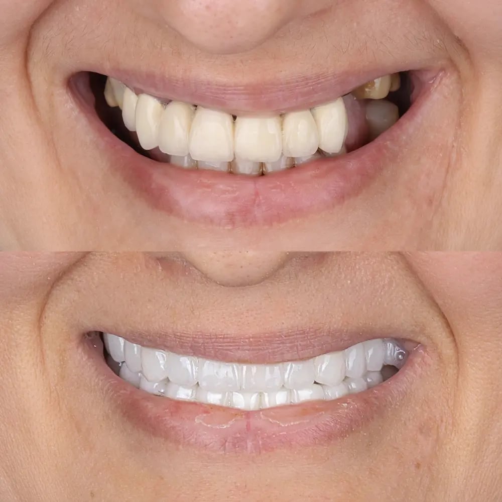 Antes e depois da colocação de prótese fixa sobre implantes com recuperação do sorriso.