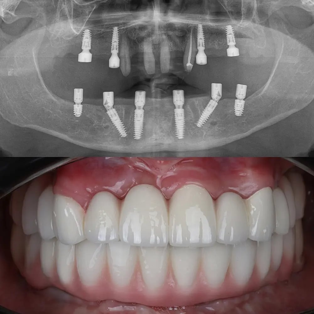 Radiografia e resultado final após colocação de prótese fixa sobre implantes.