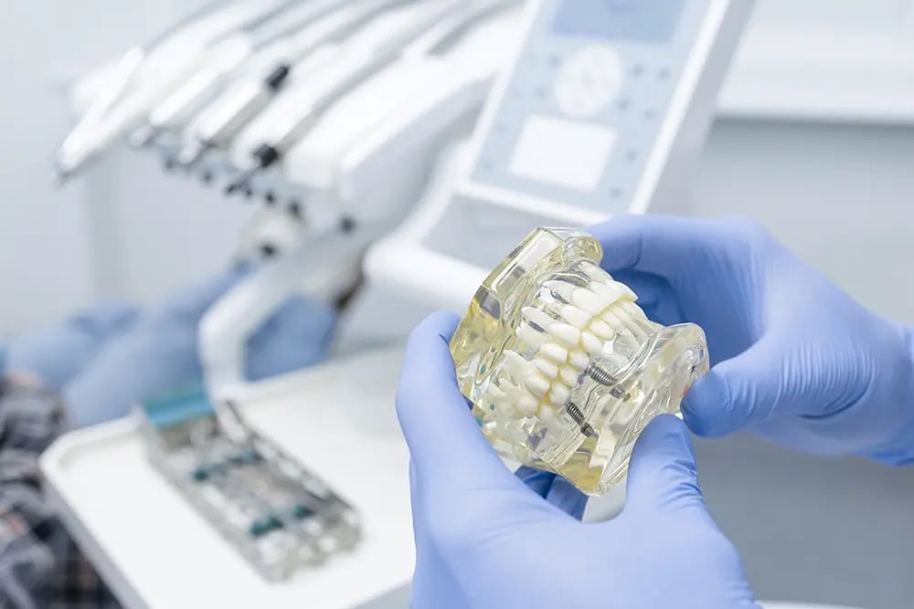 Modelo dentário com implantes nas mãos de um profissional, utilizado para demonstrar uma reabilitação oral com overdenture suportada por implantes.
