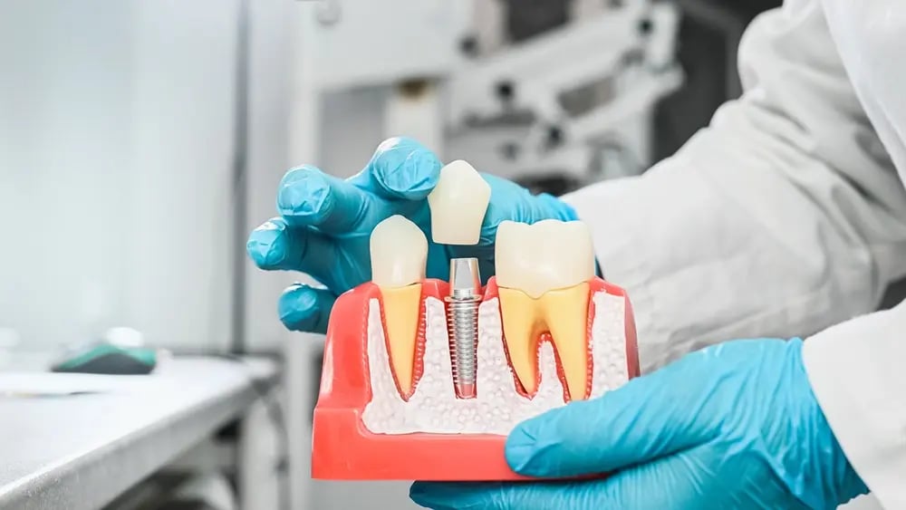 Modelo de implante dentário utilizado para explicar o preço do tratamento ao paciente.