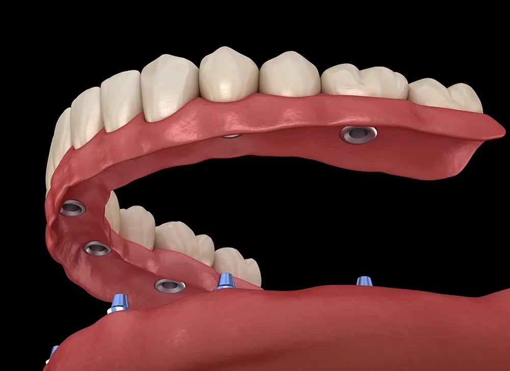 Esquema de overdenture suportada por quatro implantes dentários para maior estabilidade da prótese.