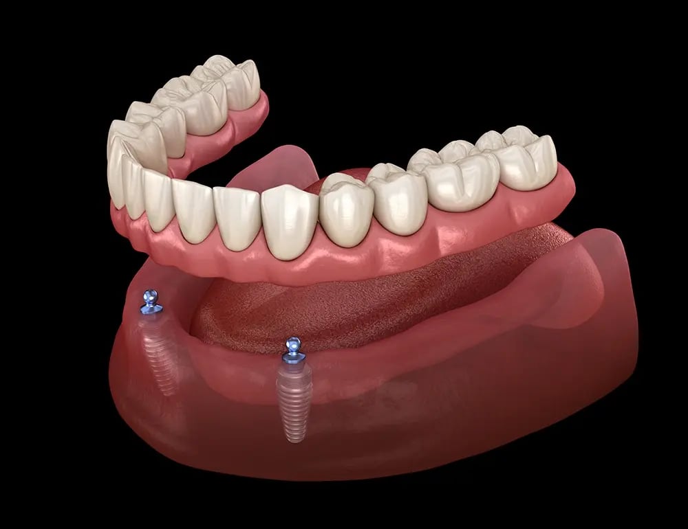 Overdenture removível apoiada em dois implantes dentários, ilustrando o sistema de encaixe que proporciona maior estabilidade do que uma dentadura convencional.