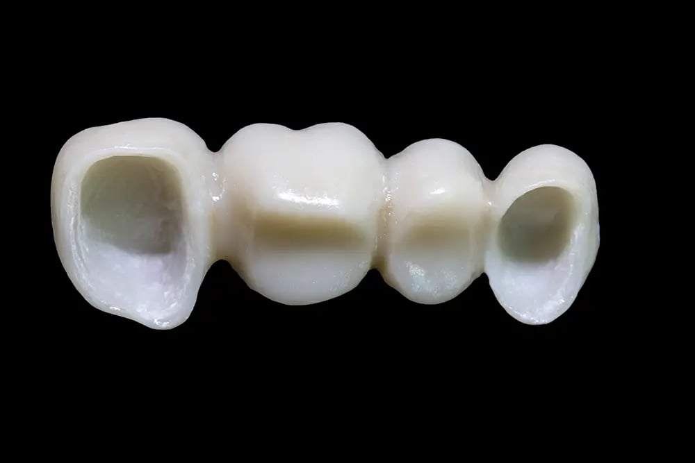Prótese dentária fixa utilizada na reabilitação oral personalizada