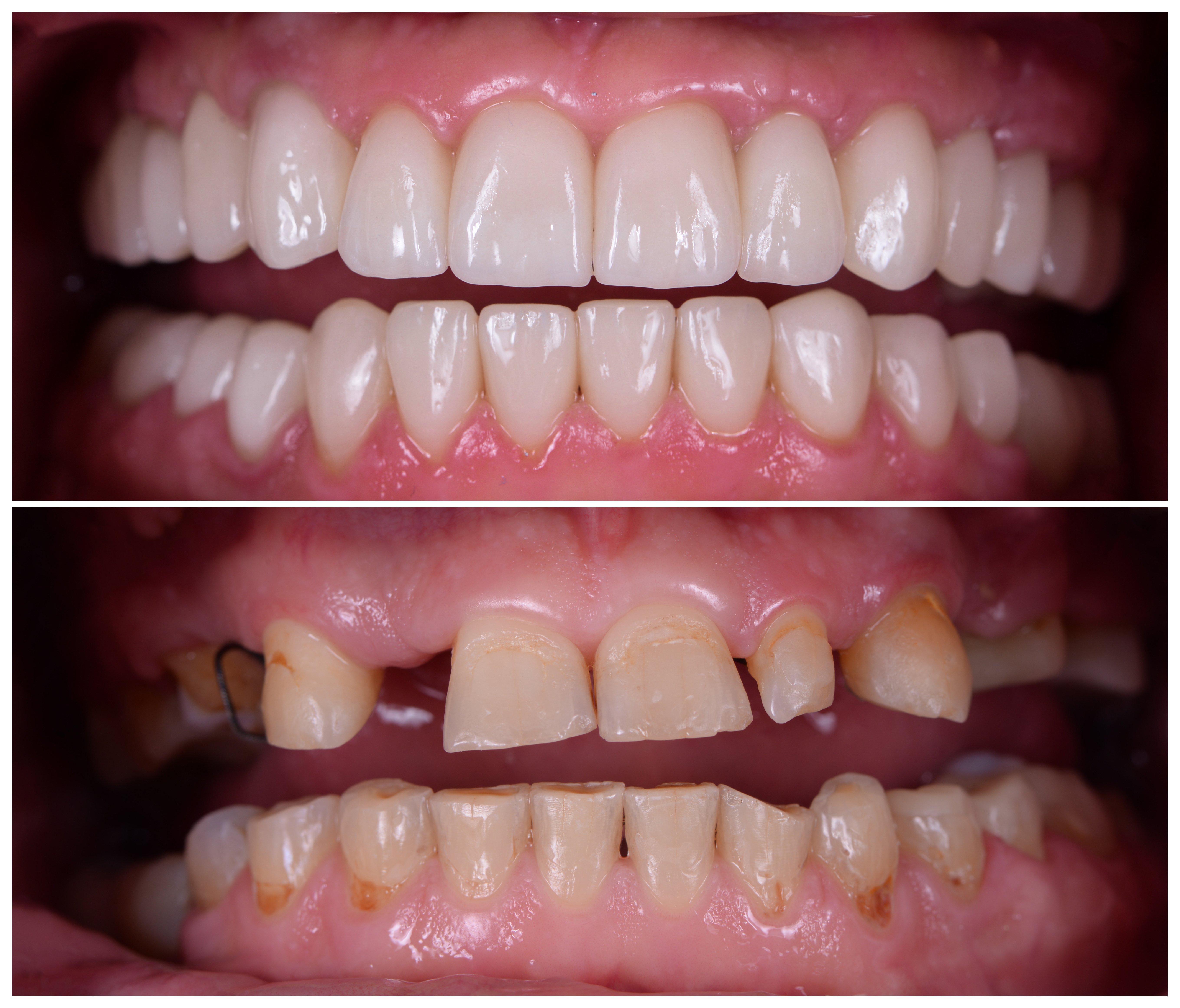 AdobeStock_34151440Comparação entre uma situação de perda dentária e o resultado obtido com uma prótese fixa sobre implantes.