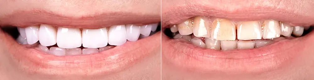 Antes e depois de uma reabilitação oral com prótese fixa sobre implantes, evidenciando a melhoria da estética do sorriso, da cor e do alinhamento dos dentes.