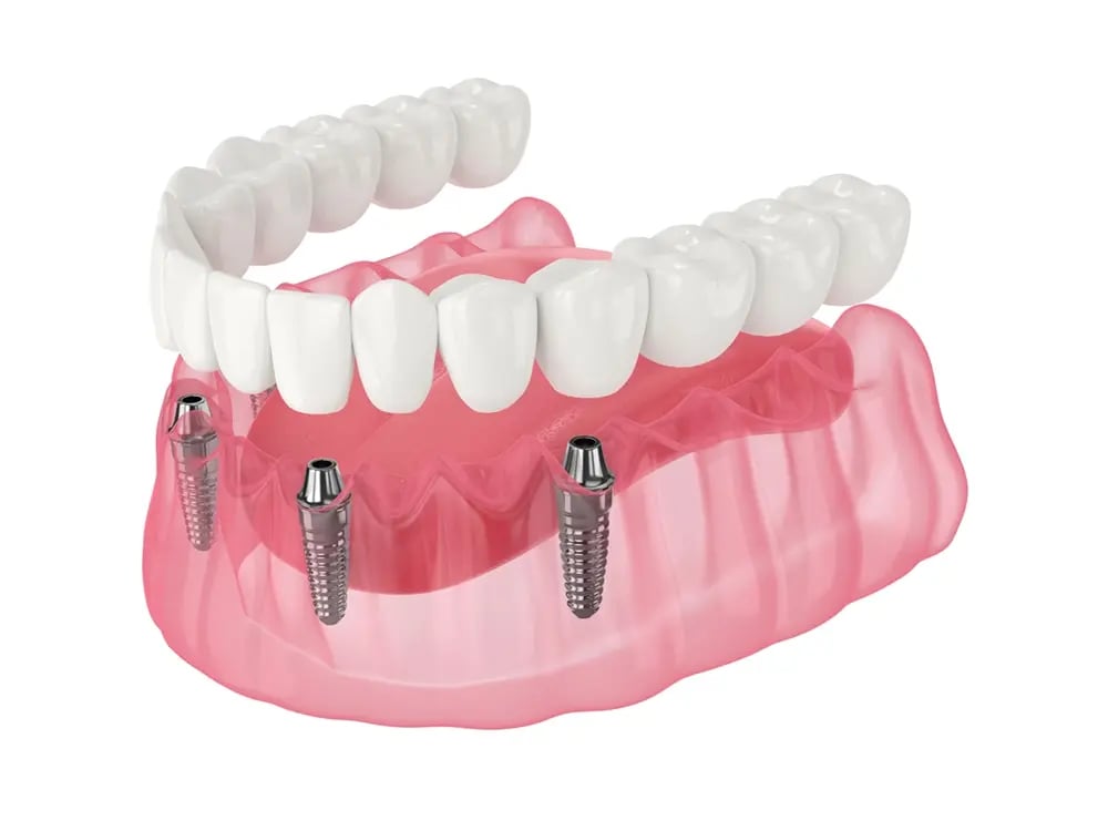 Esquema de prótese fixa sobre implantes suportada por quatro implantes dentários..