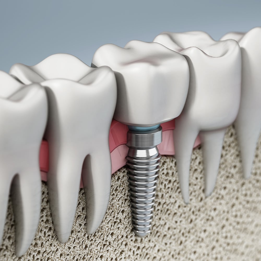 Representação de um implante dentário com coroa fixa sobre o implante.
