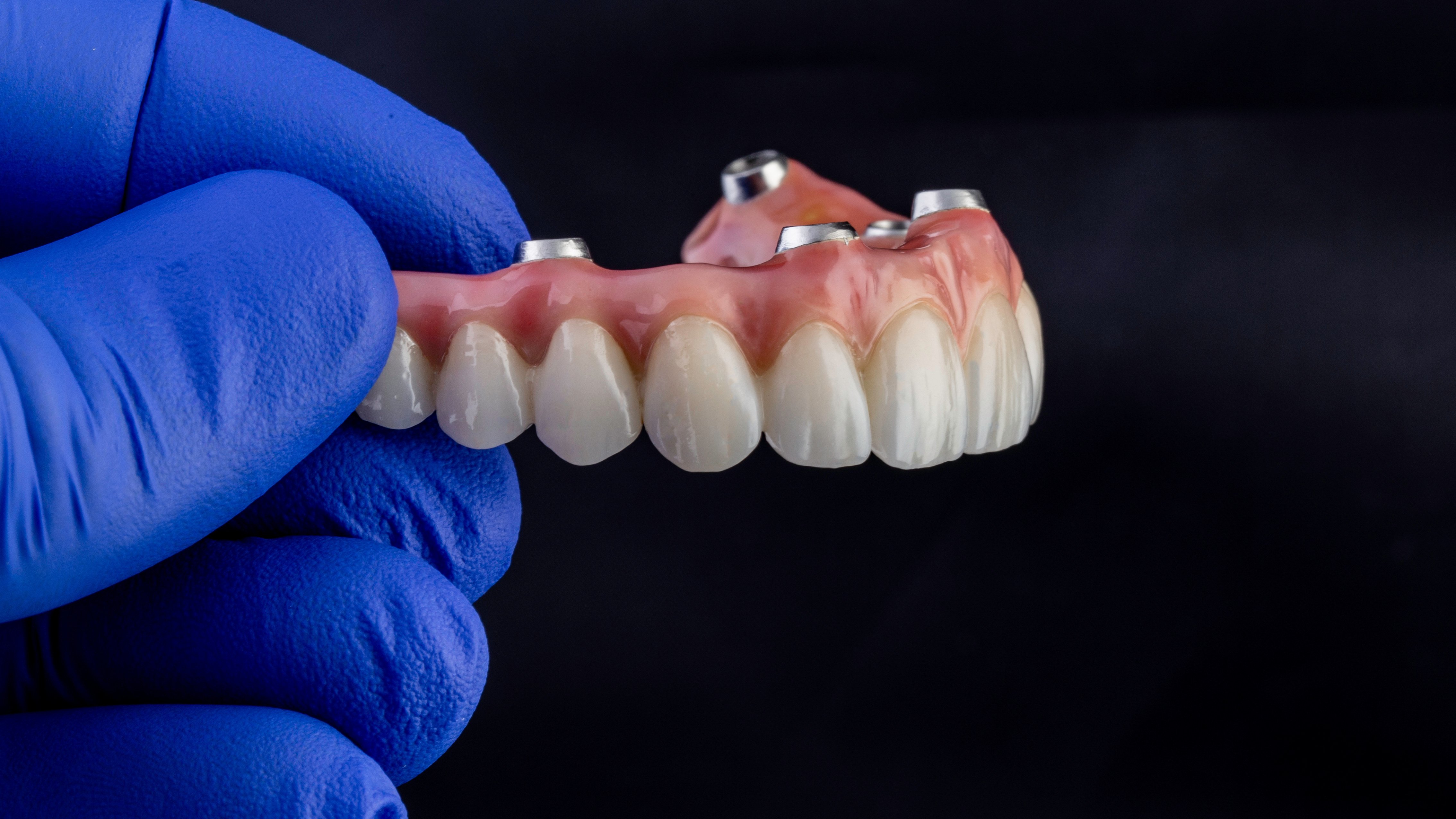 Prótese fixa sobre implantes dentários utilizada no planeamento de reabilitação oral personalizada