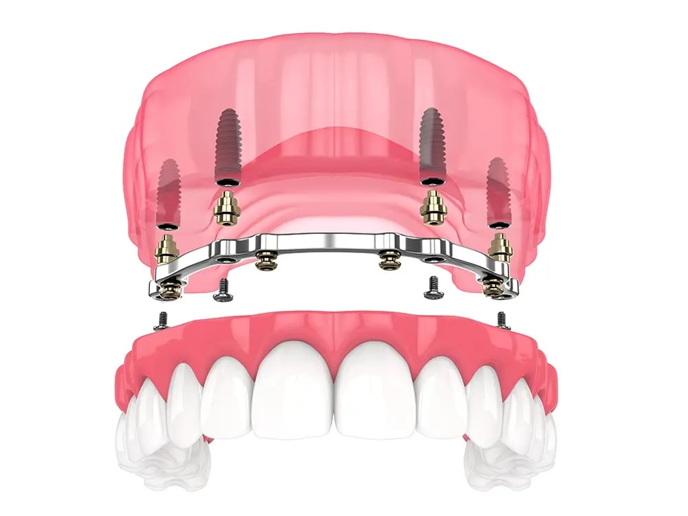 Ilustração de uma overdenture com estrutura aparafusada