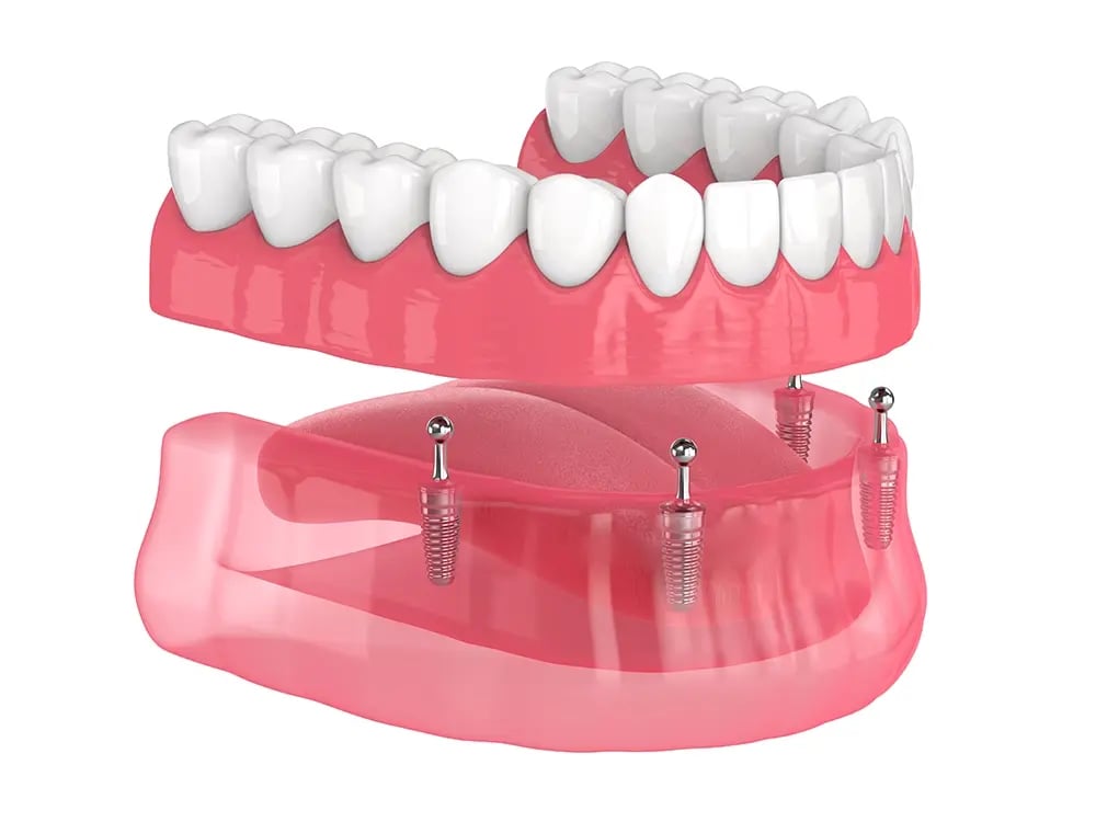 Overdenture removível apoiada e estabilizada por implantes dentários.