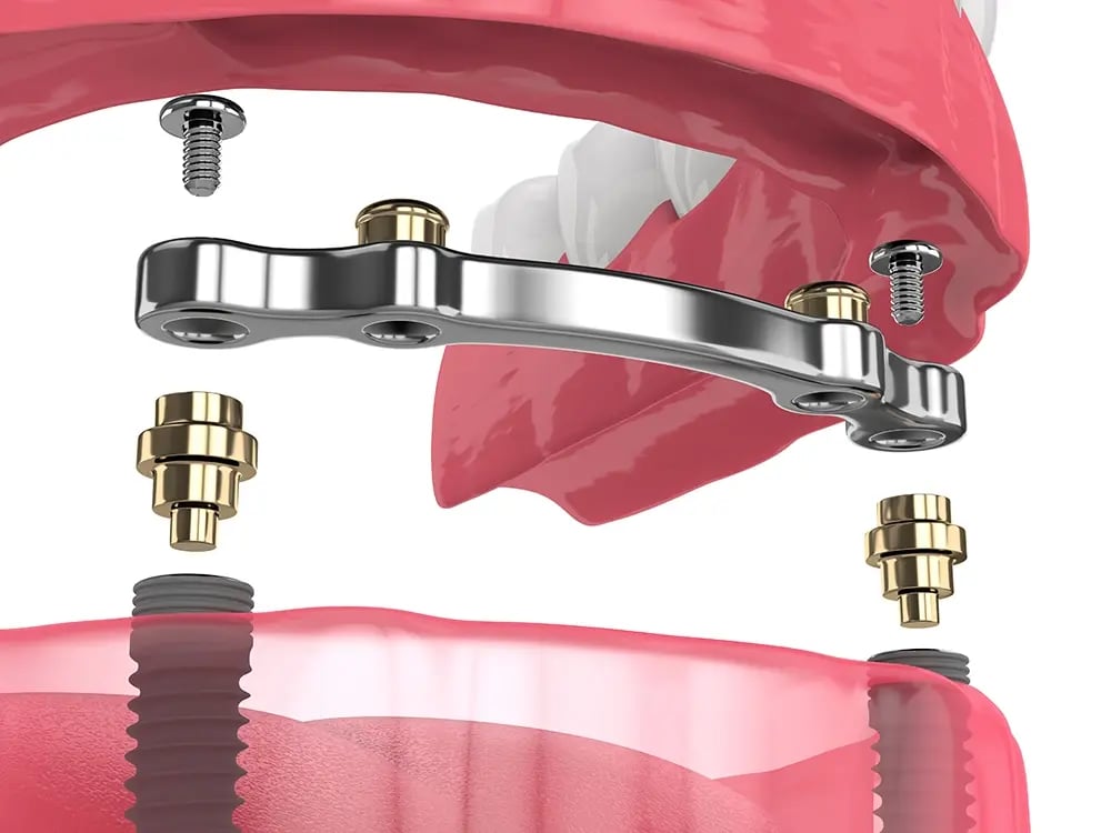 Ilustração do sistema de encaixe de uma overdenture sobre implantes dentários.