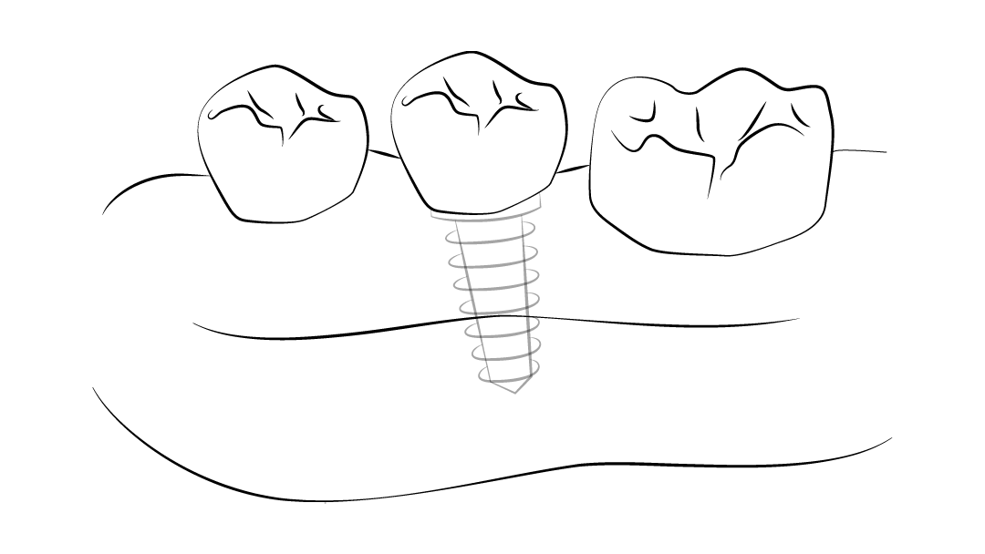 Prótese Fixa em 24h OralPlan, Implantes Dentários OralPlan