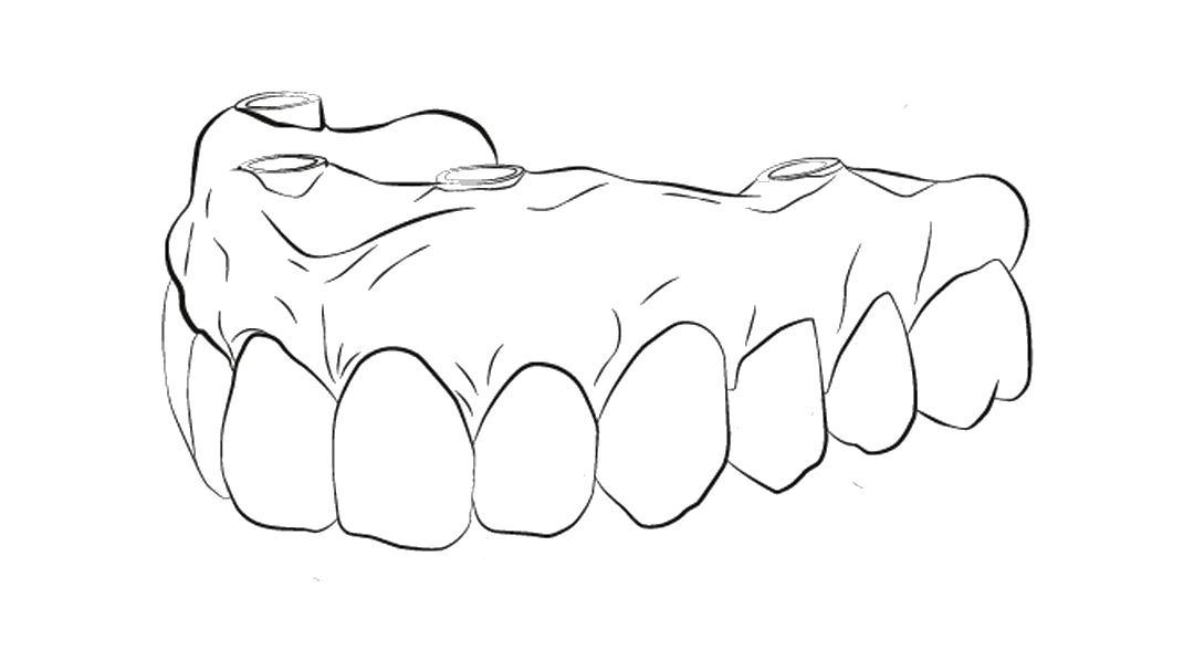 Prótese Fixa em 24h OralPlan, Implantes Dentários OralPlan