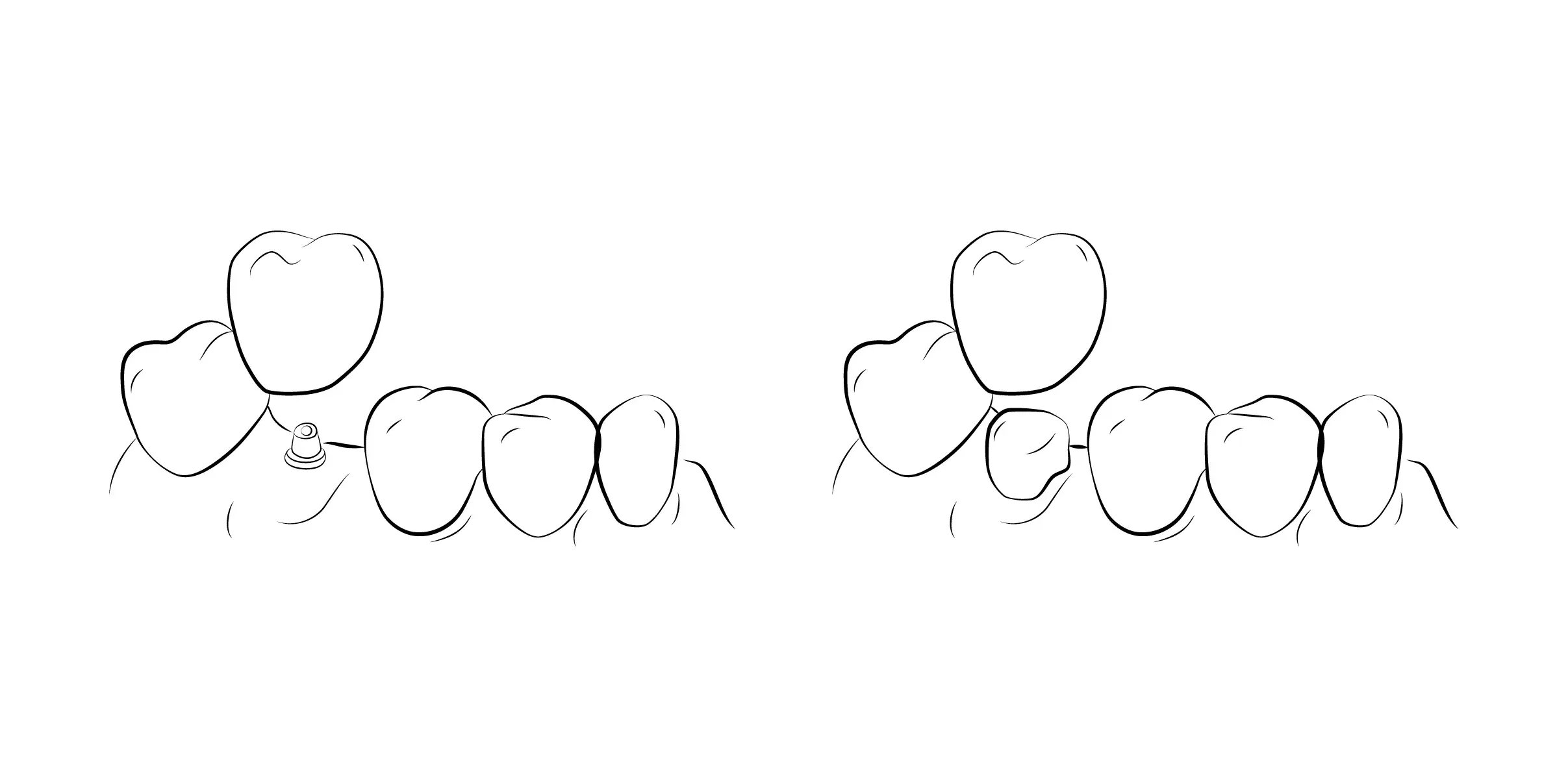 Exemplo Prótese Fixa