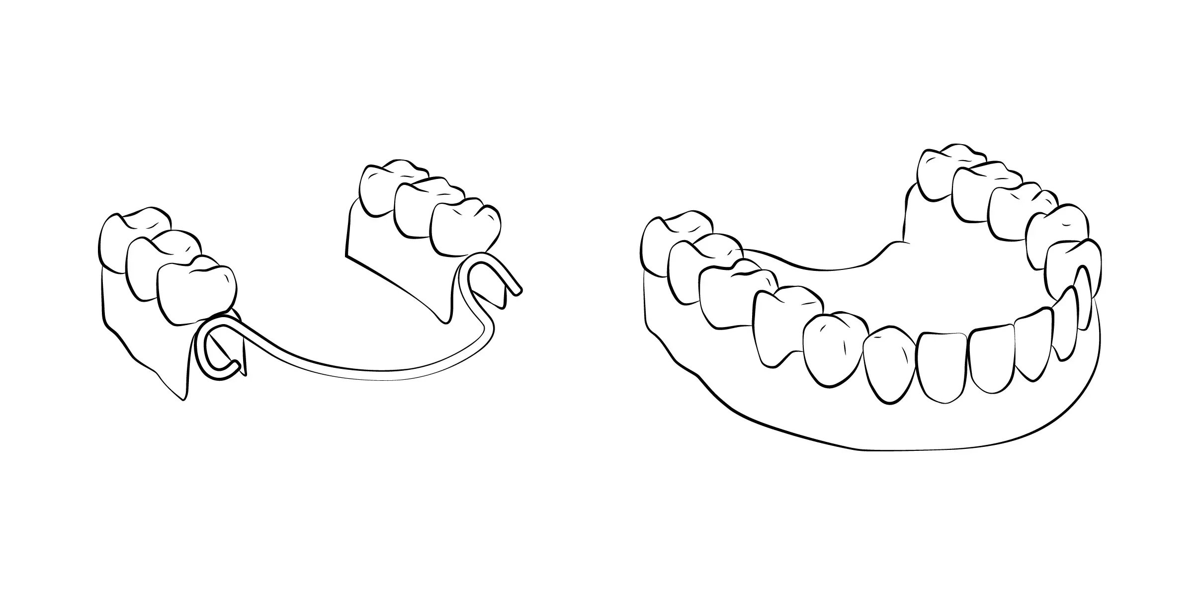 Exemplo Prótese Removível