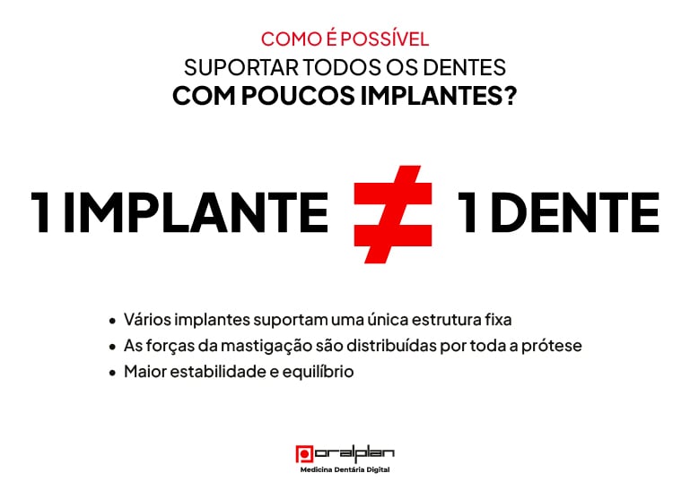 Infografia que explica como vários implantes dentários podem suportar uma prótese completa de forma estável