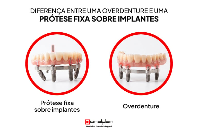 Diferença entre uma overdenture e uma prótese fixa sobre implantes 