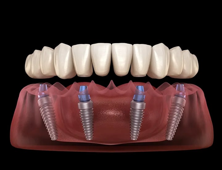 OralPlan_all-on-4