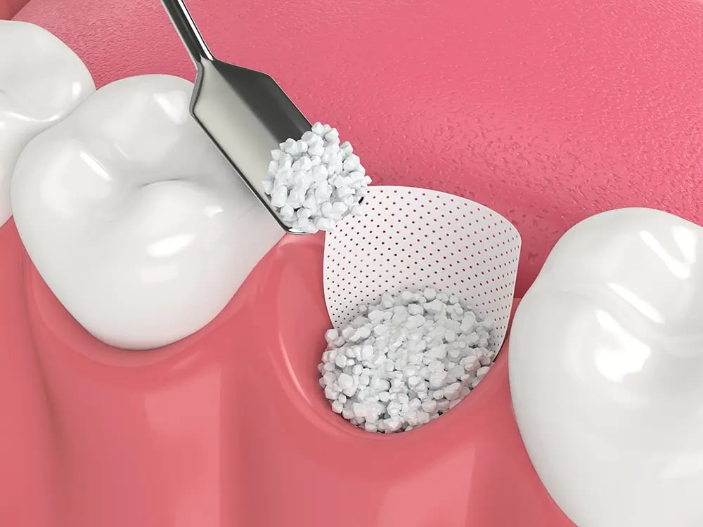 OralPlan_falta de osso-1