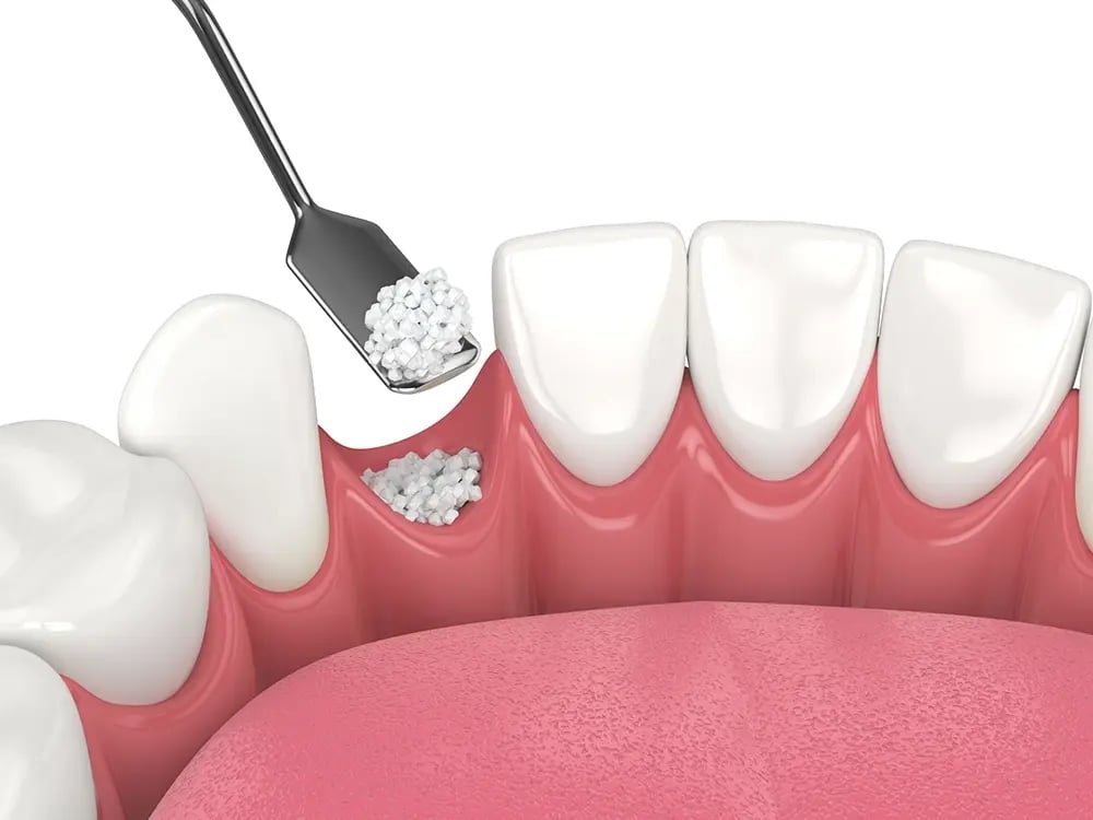 OralPlan_falta de osso
