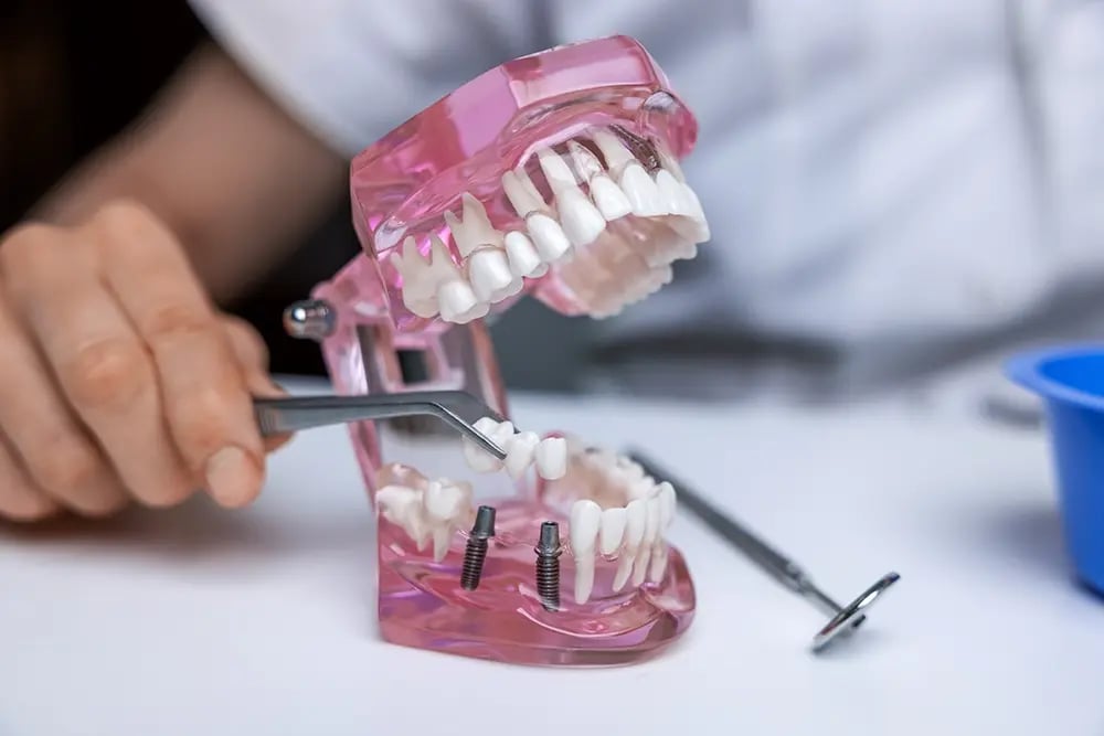OralPlan_ponte sobre implantes
