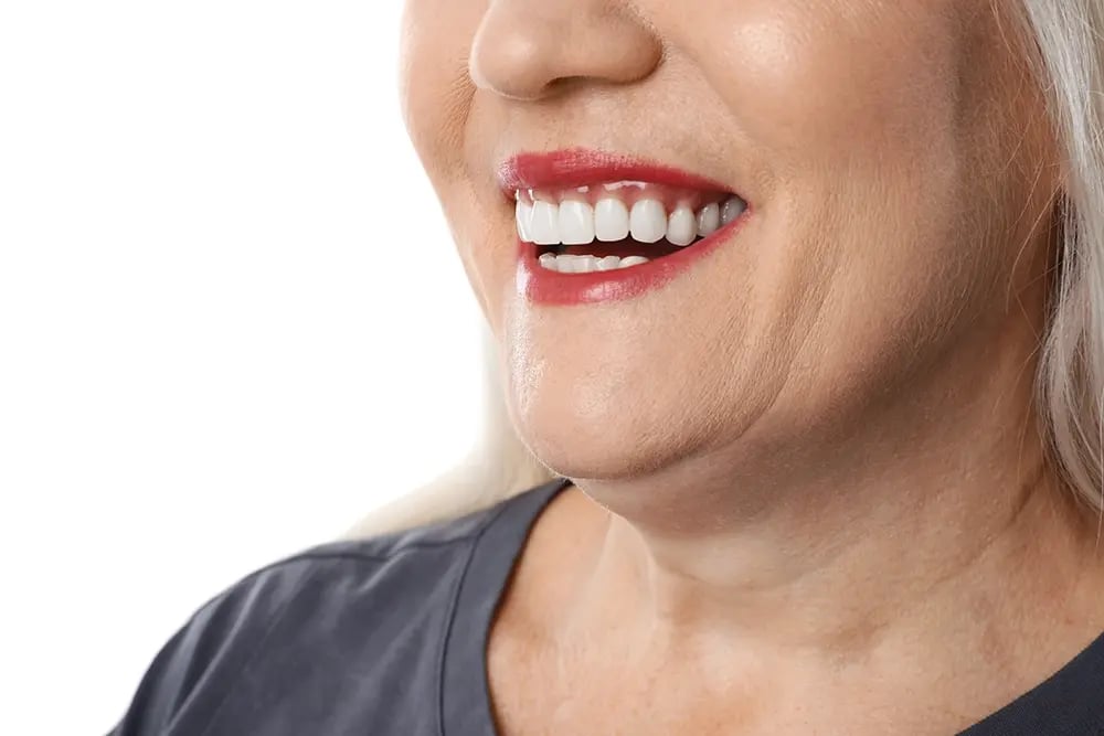 Mulher a sorrir, de modo a mostrar uma prótese fixa sobre implantes com aspeto natural.