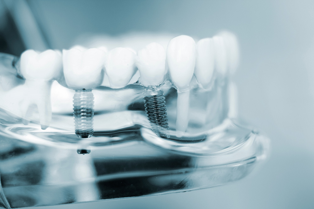 O paciente sai com implantes dentários e dentes fixos no mesmo dia?
