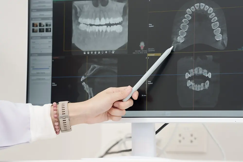Overdenture ou prótese fixa: qual é a melhor opção?