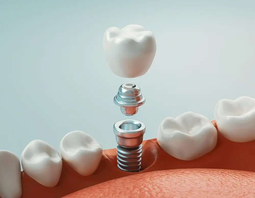 Os implantes dentários da OralPlan parecem dentes naturais?