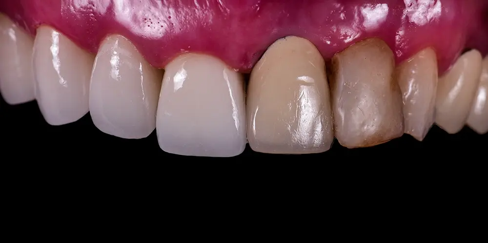 É possível colocar uma prótese fixa sobre implantes no próprio dia?