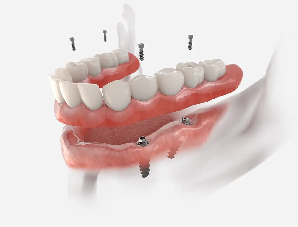O que é uma prótese fixa sobre implantes?