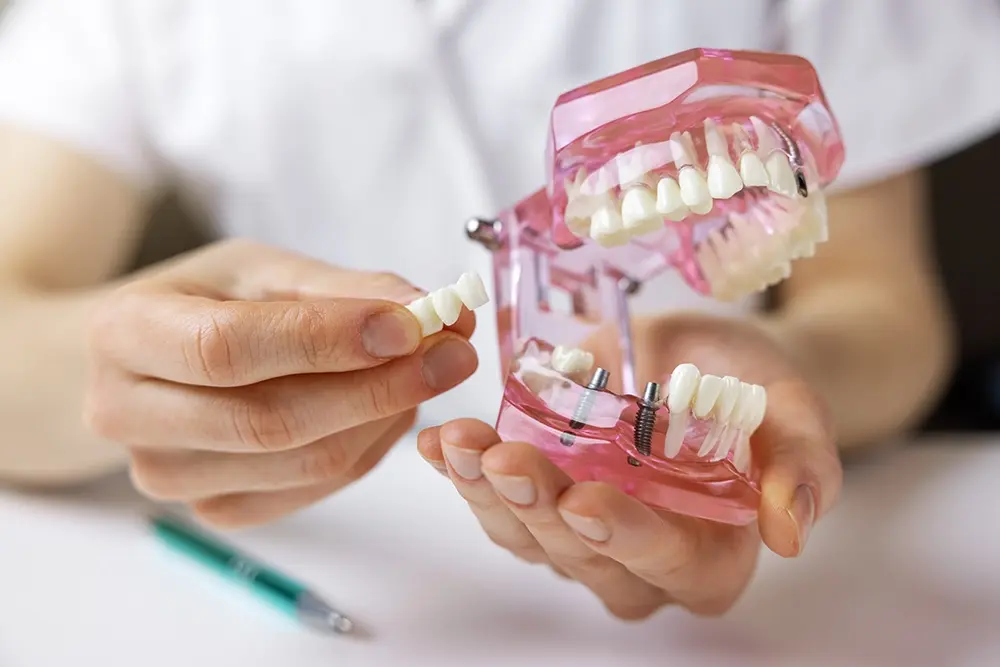 Como sabemos se alguém é candidato a implantes dentários?