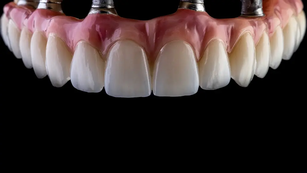 Como são usados apenas alguns implantes dentários para suportar todos os dentes?