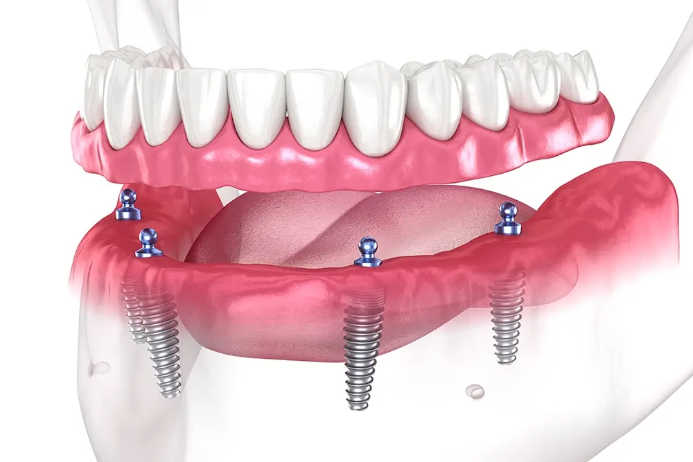 Overdenture: O que é e como funciona?