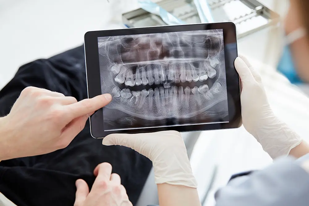 É possível colocar implantes dentários na OralPlan se tiver pouco osso?