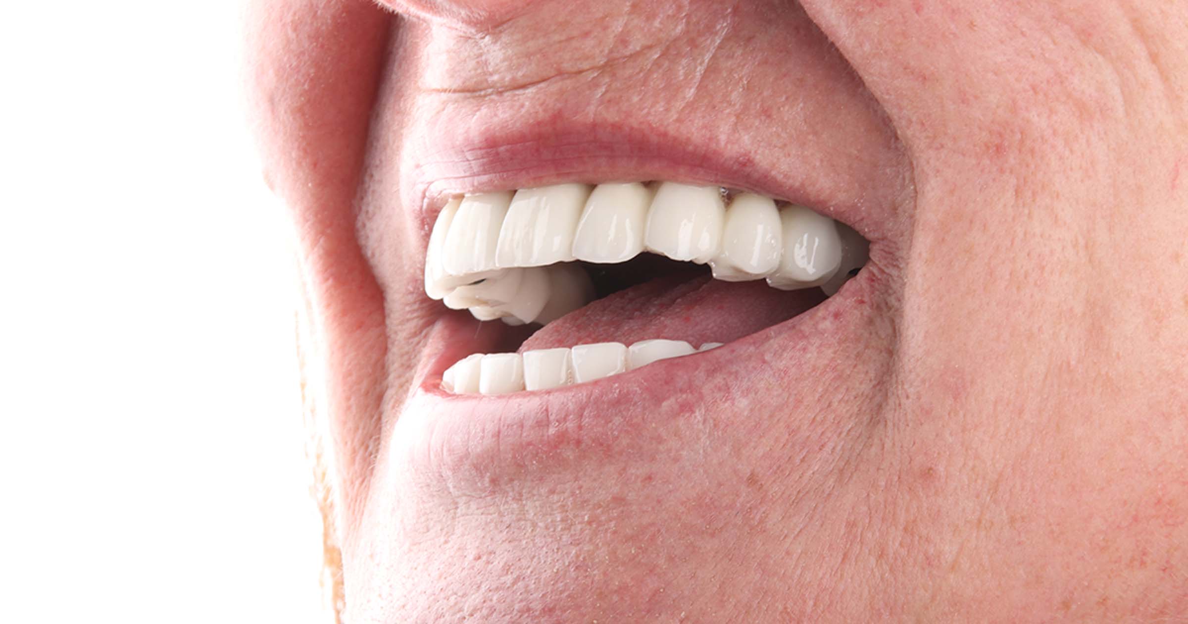 Vantagens do All-on-4® para quem já perdeu todos os dentes
