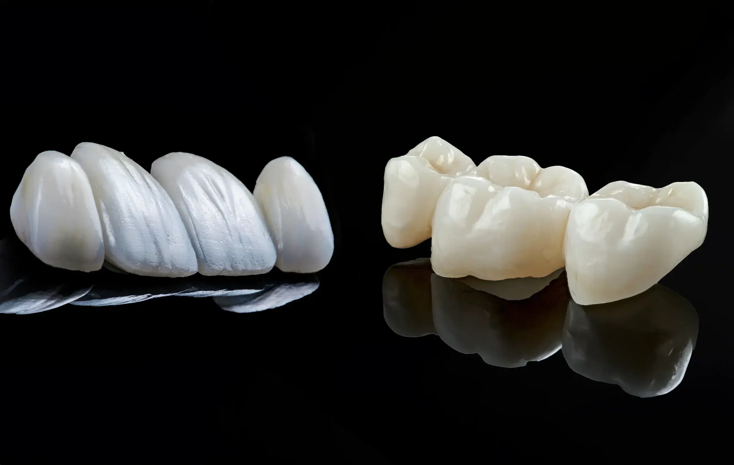 Qual a diferença entre facetas dentárias e coroas dentárias?