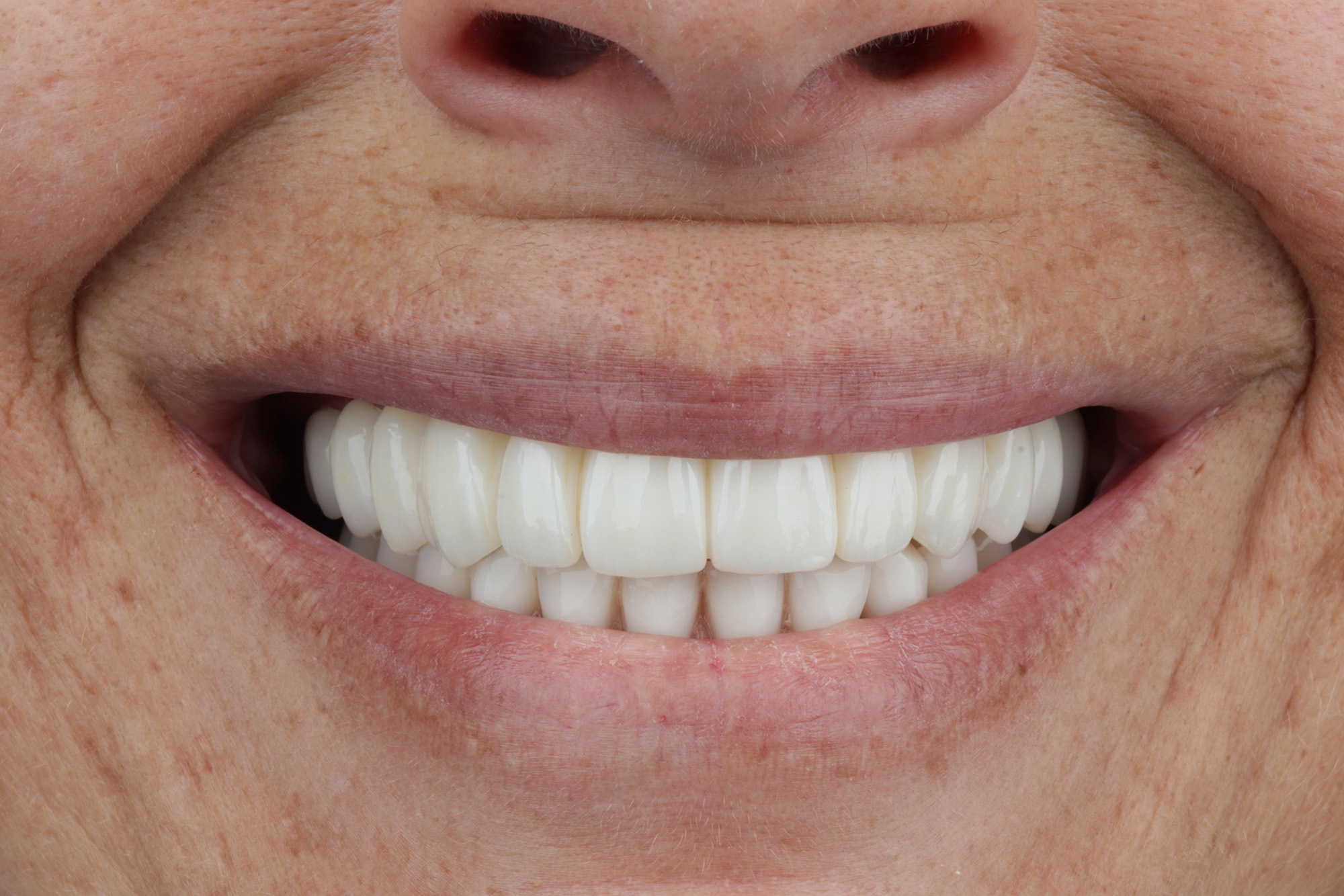 Como é colocado um implante dentário quando existe perda óssea