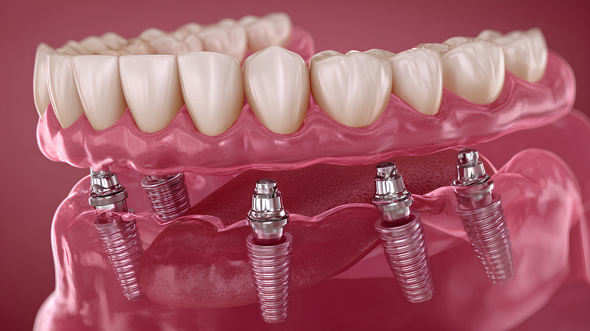 Mitos e Verdades sobre os implantes All-on-4®: o que deve saber