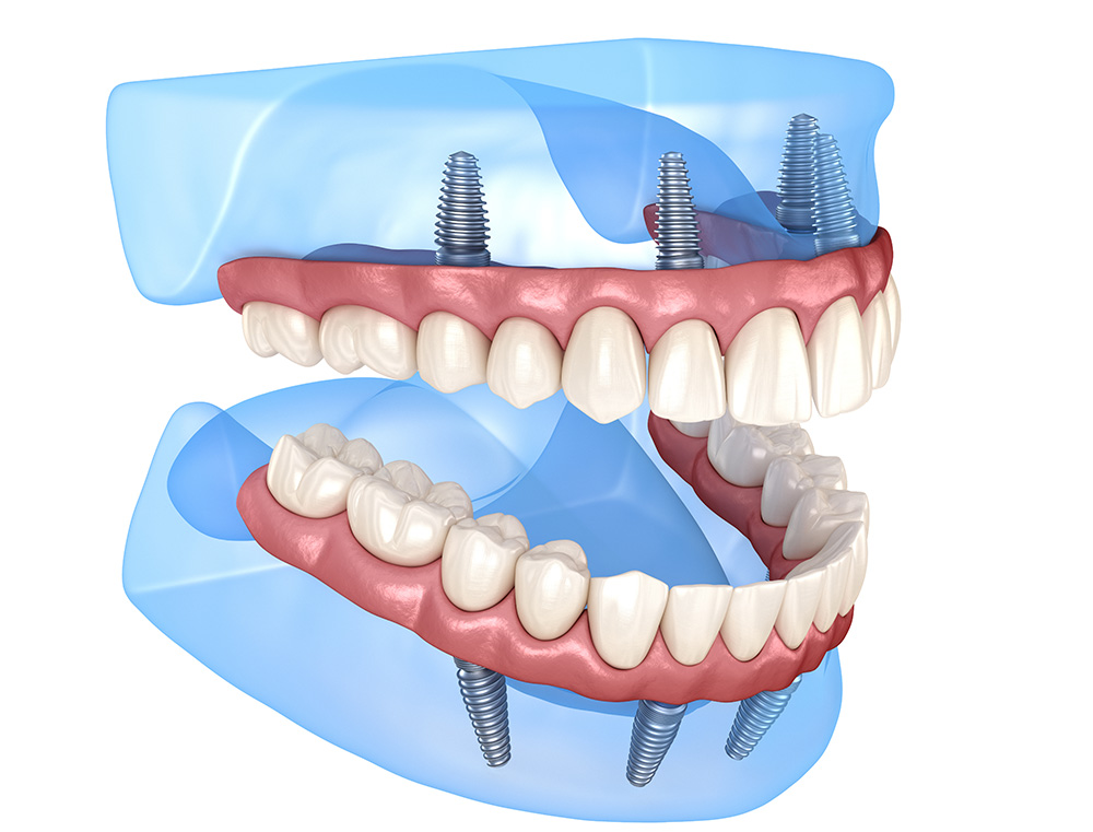 Sentirei dor no tratamento All-on-4®?
