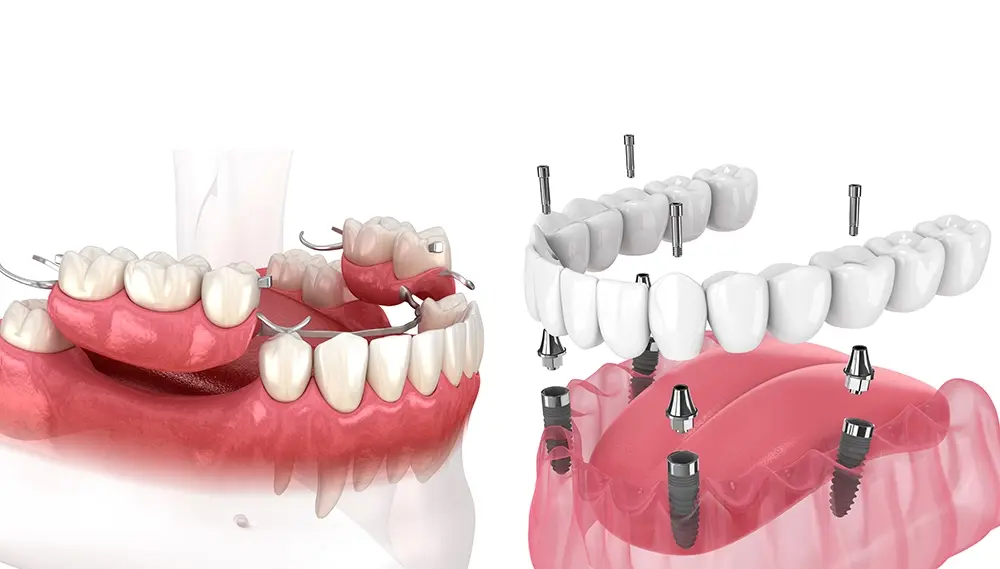 Qual a diferença entre a prótese fixa sobre implantes e prótese removível?
